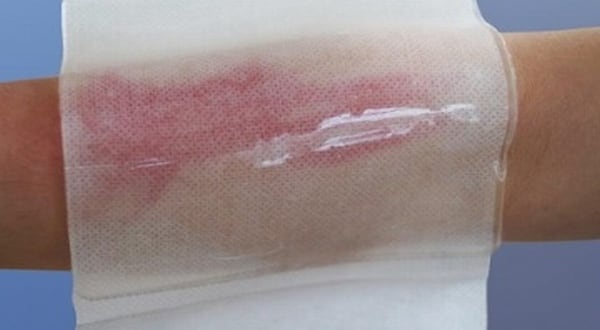 Jempol! Mahasiswa IPB Rancang Hidrogel Penutup Luka Berbahan Kelapa Sawit